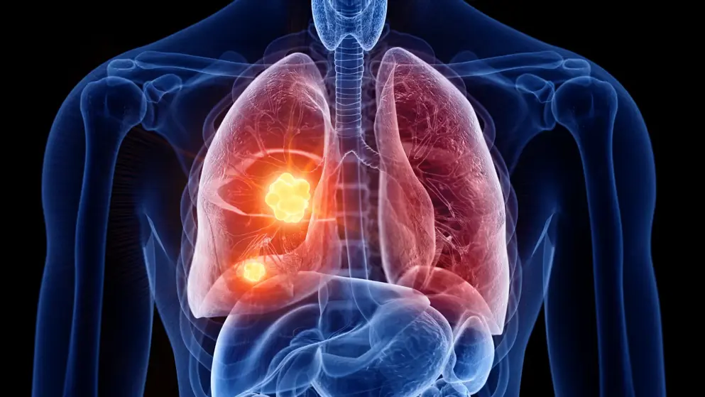 3d image of lung cancer