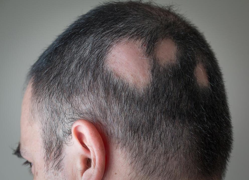 Alopecia on a mans head